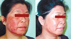 Công nghệ mới trị nám, thâm, nhăn, nhờn da…