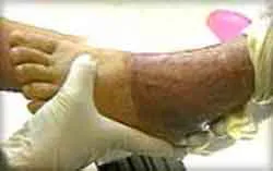 Lương y Triệu Thị Liên với bài thuốc chữa bỏng thần kỳ