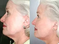 Căng da mặt bằng Laser YAG thế hệ mới