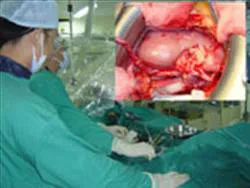 Thay đổi phong cách sống có thể ngừa bệnh mạch vành