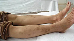 Bài 2: Tắm trắng - Dịch vụ… tàn phá da!