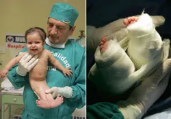 Tách chân thành công cho cô bé "Người cá"