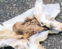 Lấy miếng gạc bị bỏ quên trong ổ bụng từ 8 tháng trước