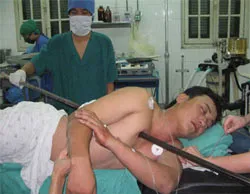 Cứu sống một bệnh nhân bị xà beng xuyên thủng ngực