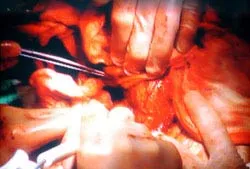 Việt Nam thực hiện ca ghép gan thứ 3