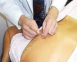 Châm cứu để làm đẹp?