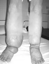 Phù chân voi do giun chỉ