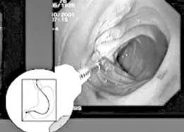 Vai trò H. Pylori trong loét dạ dày tá tràng
