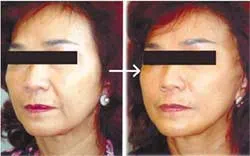 Căng da mặt, nâng chân mày... bằng chỉ