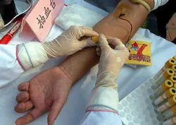 Bán máu nhiễm HIV làm 21 người bị lây bệnh