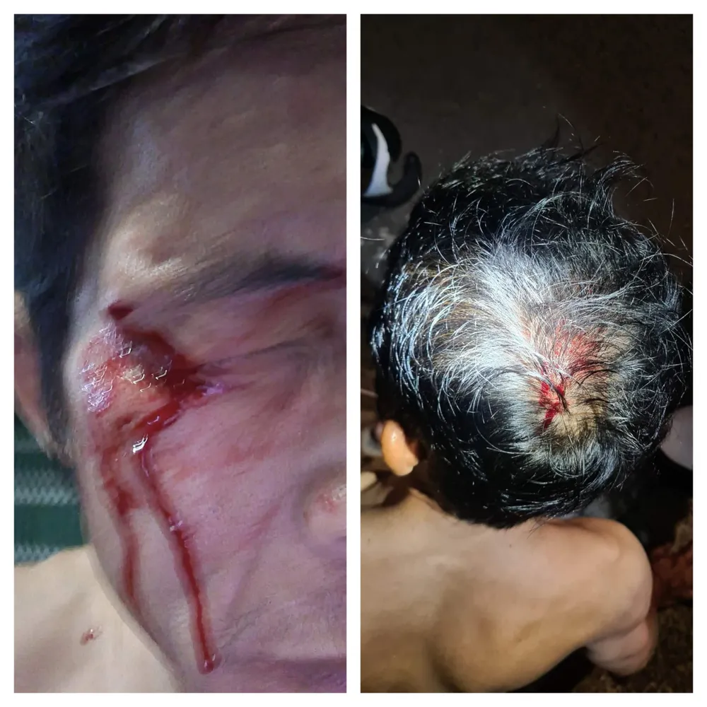 Ông T. bị thương vùng đầu, rách mí mắt