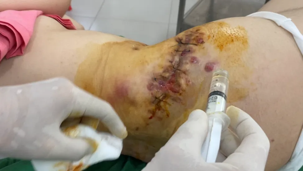Hoại tử vì tiêm thuốc tan mỡ bụng, nữ bệnh nhân phải phẫu thuật 5 lần  ảnh 1