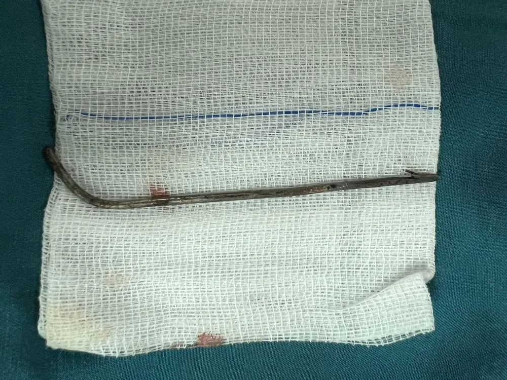 Mũi tên bắn cá bằng sắt có móc dạng lưỡi câu xuyên vào người từ sau lưng anh Hồ Văn V.