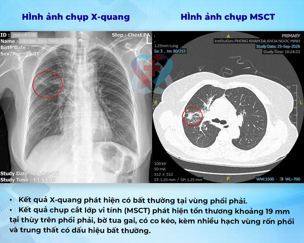 KẾT QUẢ CHỤP X-QUANG VÀ MSCT.png