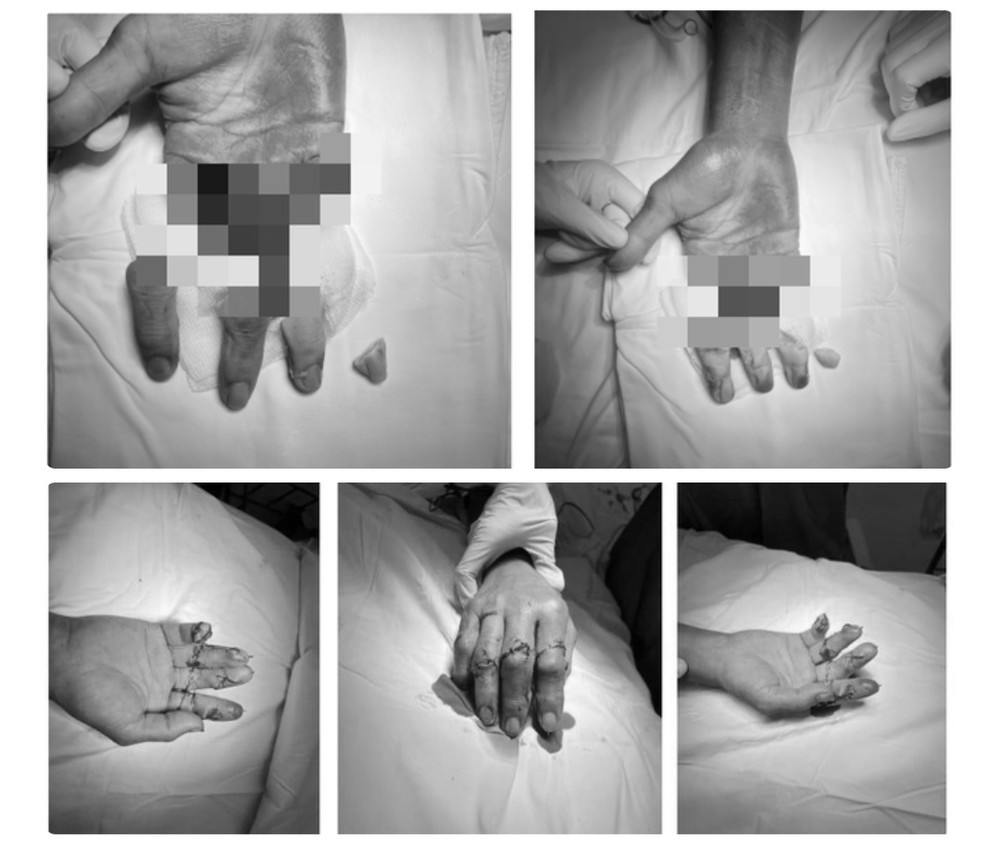 手指断离及经医生手术再植后的图片。