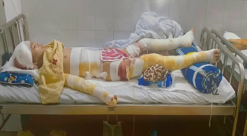 Cháu trai bị bỏng nặng không có tiền chữa trị