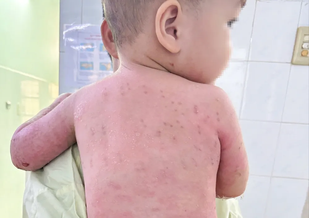 Cơ thể bé B.P.T trước ngày xuất viện. Kỹ thuật ghép da đã giúp vết phỏng hồi phục