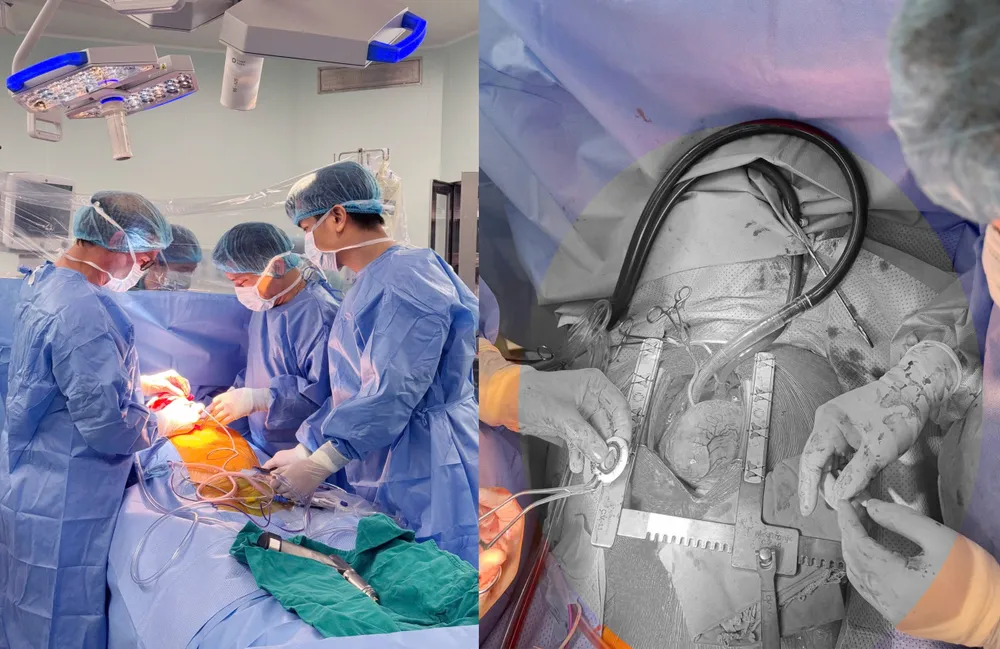 Ca cấy ghép thiết bị hỗ trợ tim CorHeart 6 đầu tiên tại Việt Nam