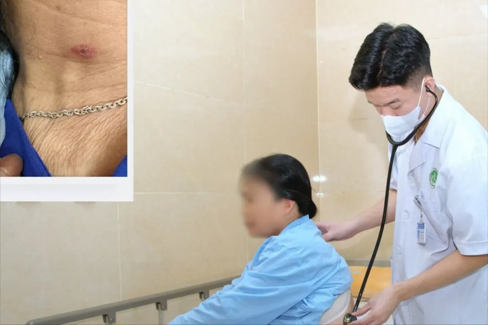 Vết loét nhỏ ở cổ giúp bác sĩ định hướng chẩn đoán sốt mò. Ảnh. BVCC
