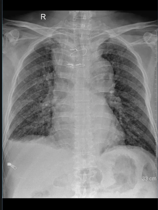 Phổi của người bệnh thông thoáng hơn sau phẫu thuật (Ảnhr: BVCC)