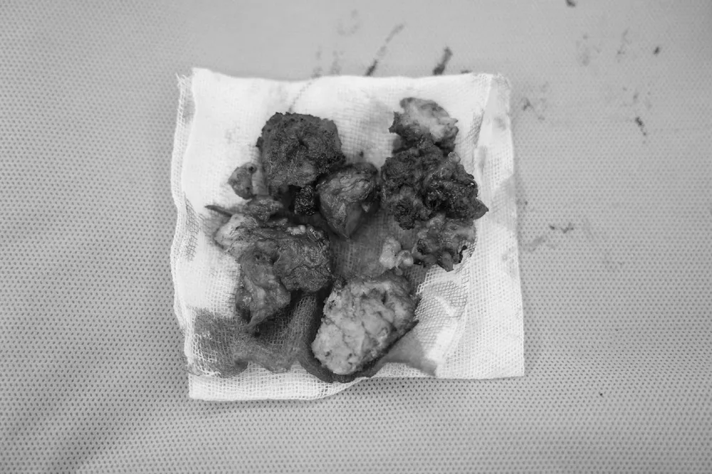 Khối u “tử thần” vừa được lấy ra khỏi cơ thể người bệnh. Ảnh: BVCC