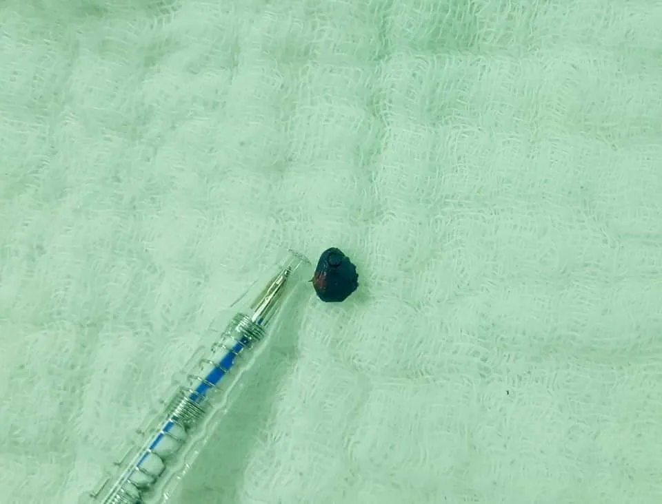 Học sinh lớp 1 bị một nhóm học sinh cùng trường nhét đất sét vào tai ảnh 2