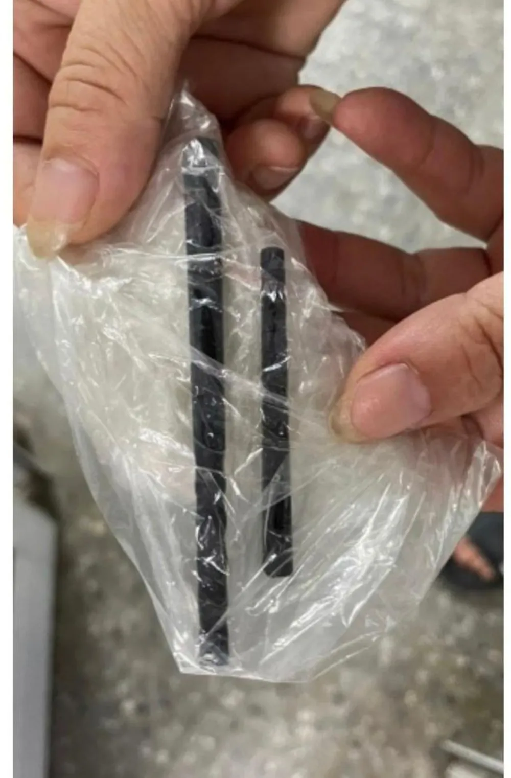 Đôi đũa lấy ra sau phẫu thuật của anh T