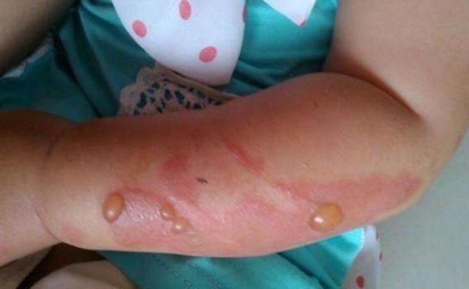 4步急救被開水燙傷小兒