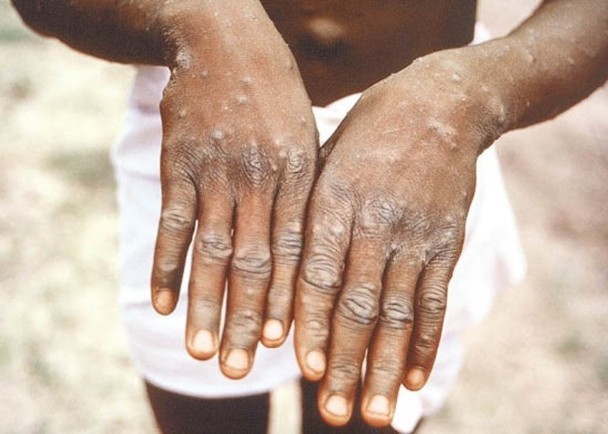 猴痘患者會長皮疹。