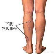 輕鬆緩解職場人靜脈曲張