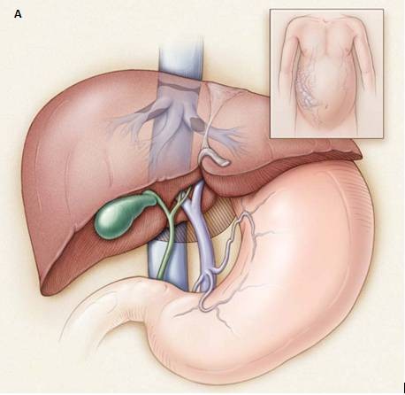 布加综合症多发于青年男性