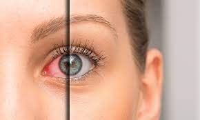 出现干涩、发红或是干眼症