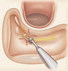 发生不寻常头晕可能是耳朵出了问题
