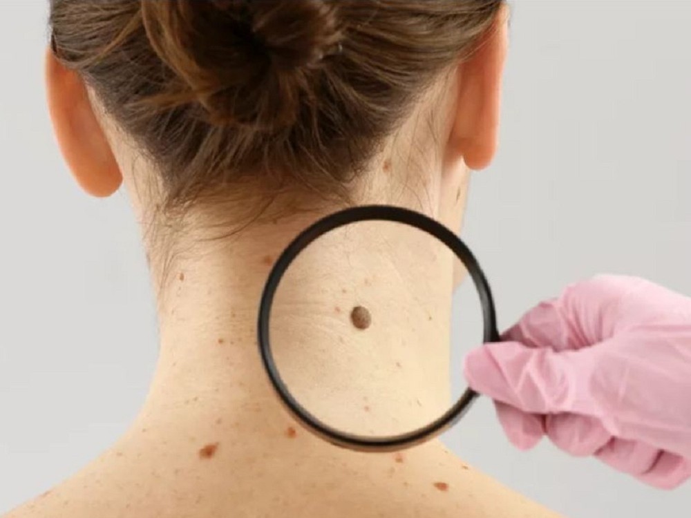皮肤黑痣要警惕癌变
