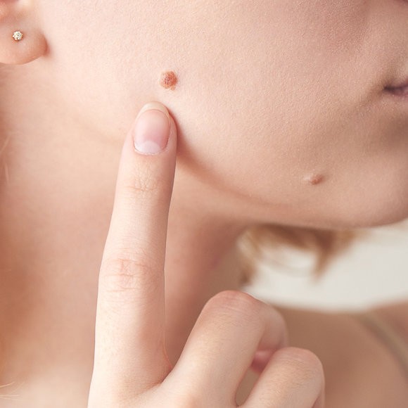 “脸上凸一颗”吓坏还会长大！