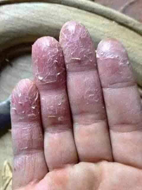 大扫除手脱皮好痛？