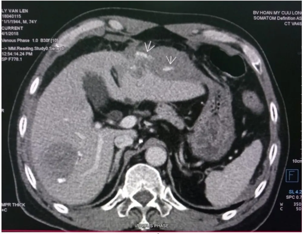 Cấp cứu thành công bệnh nhân bị vỡ khối u gan trái ảnh 1