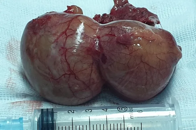 Cứu sống bệnh nhân u nang màng tim “khủng”  ảnh 1