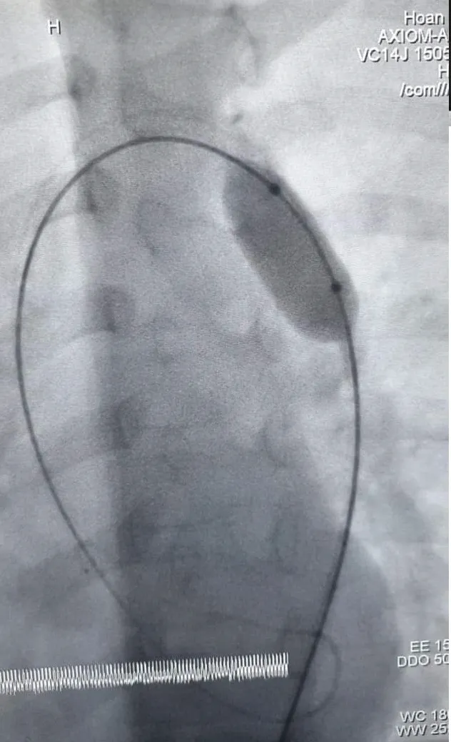 Can thiệp thành công bé 7 tuổi bị hẹp eo động mạch chủ  ảnh 1