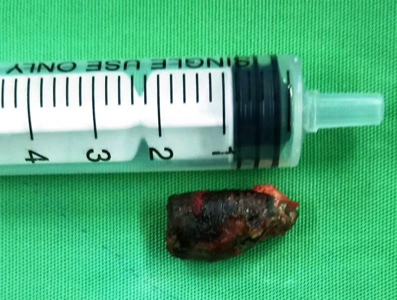 Lấy thành công đầu viên đạn nằm trong cơ thể bệnh nhân suốt 51 năm ảnh 1