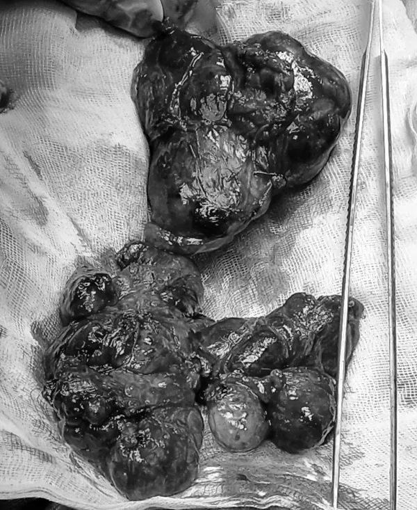 Phẫu thuật thành công bướu giáp thòng từ cổ xuống ngực ảnh 1