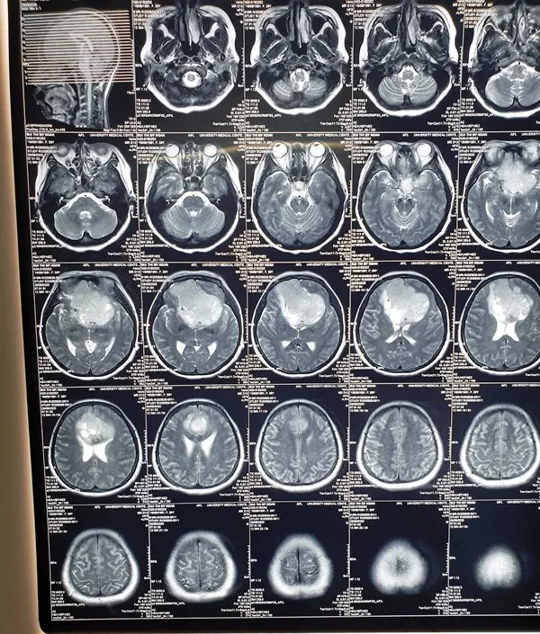 10 giờ căng thẳng phẫu thuật thành công khối u màng não lớn ảnh 1