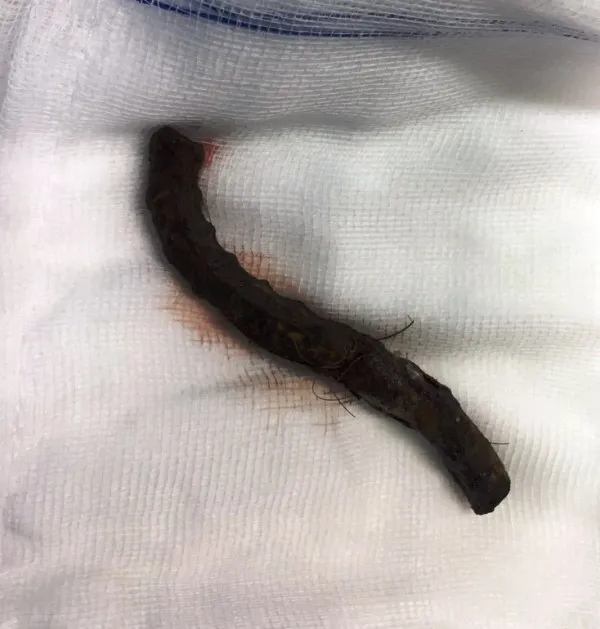 Cứu sống kịp thời bệnh nhân bị thanh sắt đâm xuyên sọ ảnh 1