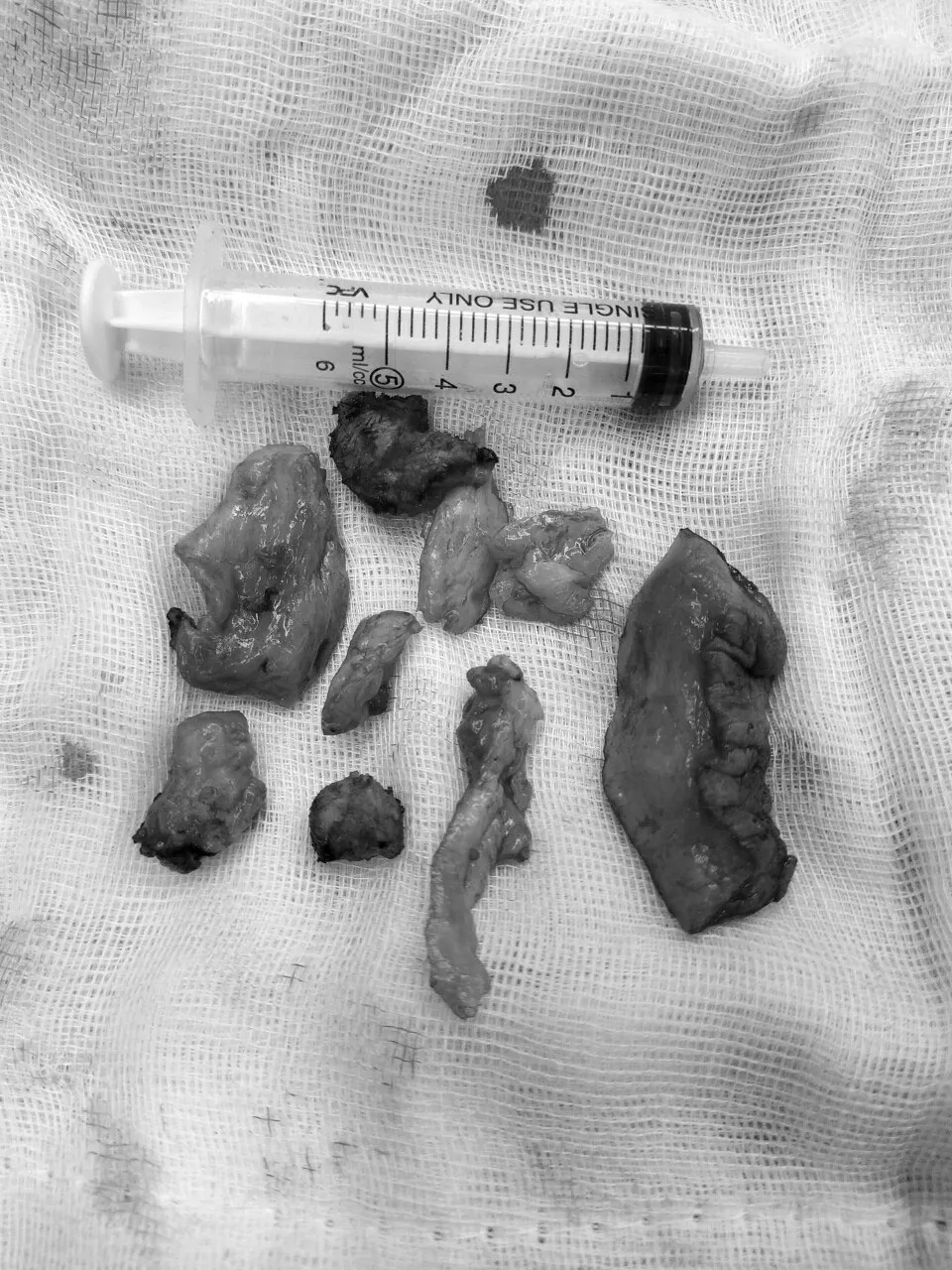 Biến dạng dương vật do bơm silicon để tăng kích thước ảnh 1