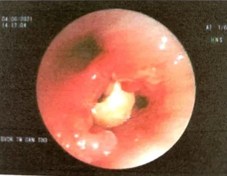 Hy hữu nửa hạt đậu phộng “chui” vào phổi cụ ông 95 tuổi ở Hậu Giang ảnh 1