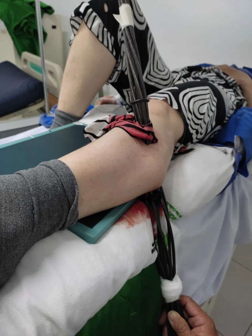 Hy hữu nạn nhân bị 7 cây sắt đâm xuyên chân  ảnh 1