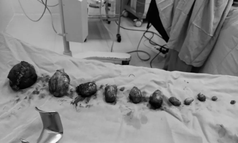 Phẫu thuật lấy thai kết hợp bóc đa nhân xơ tử cung cho sản phụ  ảnh 2