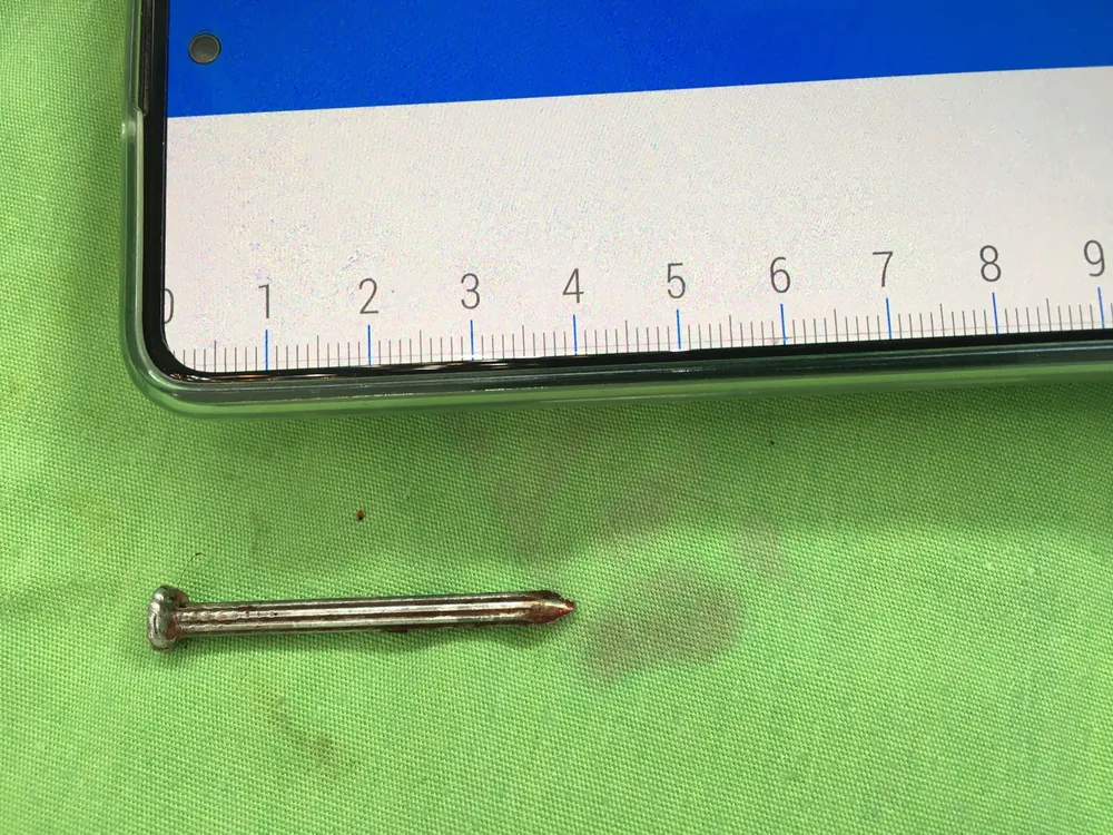 Cấp cứu kịp thời bệnh nhân tự đóng đinh vào đầu ảnh 2