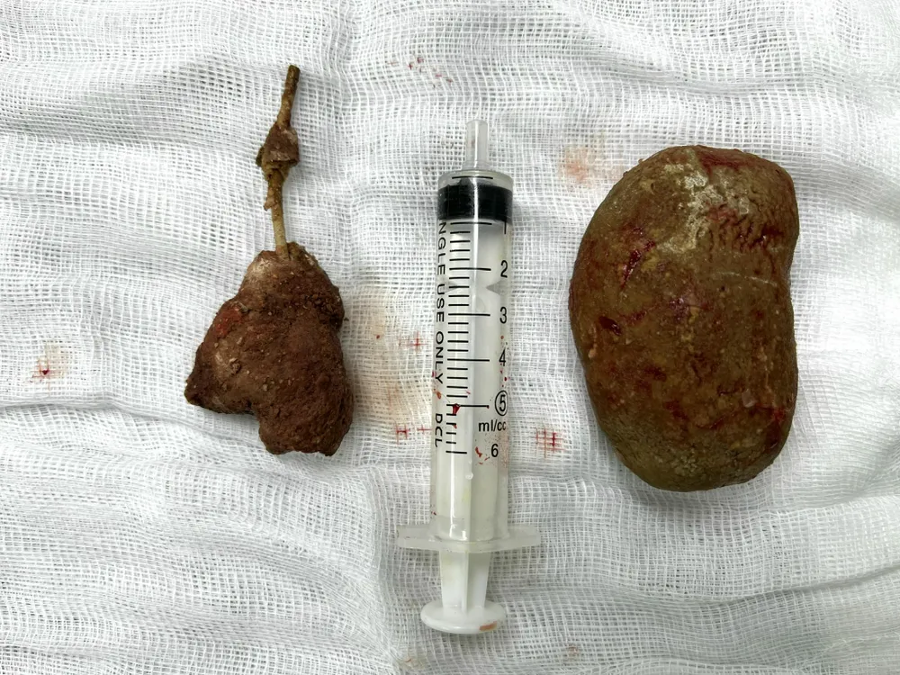 Phẫu thuật thành công cắt bỏ 2 viên sỏi bàng quang ảnh 2