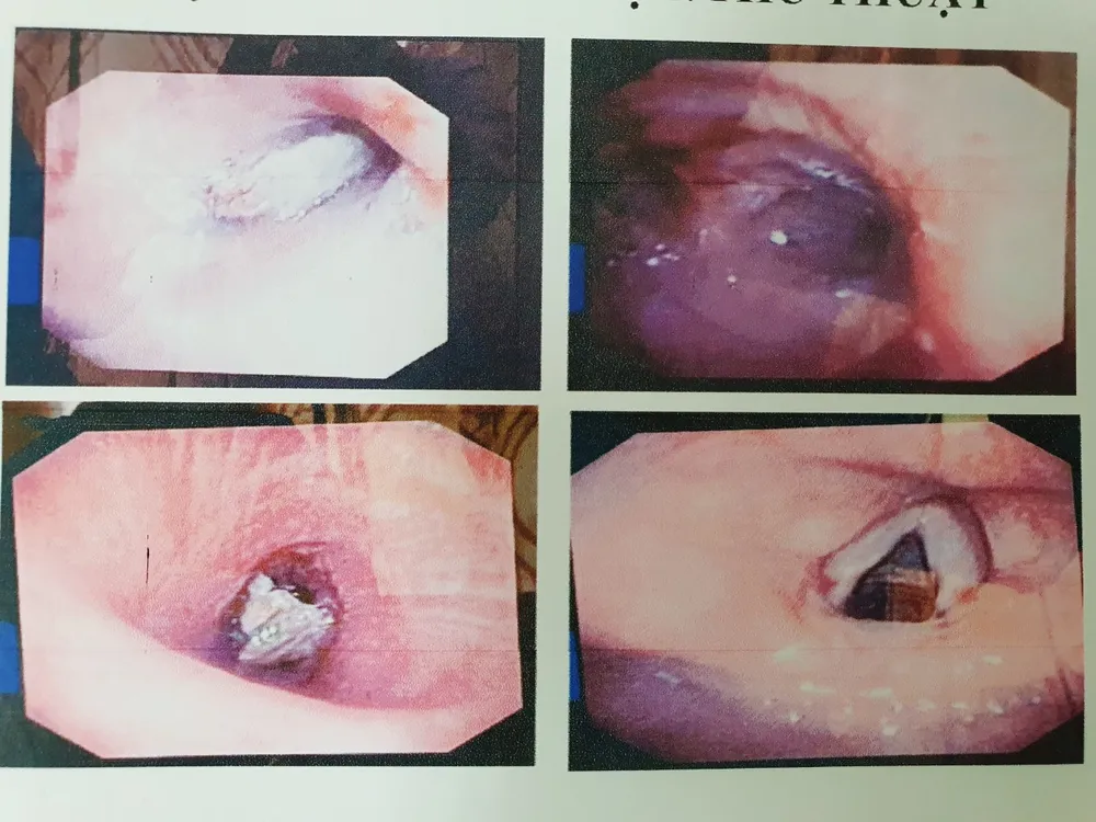 Hy hữu xương ống heo mắc trong phế quản khiến bệnh nhân khó thở gần 1 năm ảnh 2